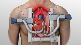 Bypass Ameliyatı Nedir? Nasıl Uygulanır?