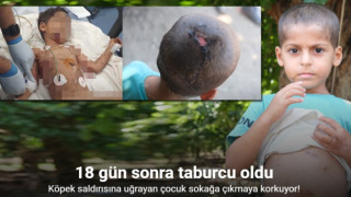 Köpeklerin saldırdığı çocuk 18 gün sonra taburcu oldu